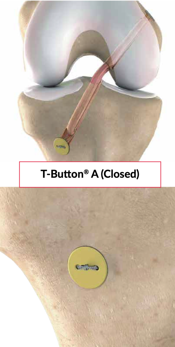 T-BUTTON with (90mm) Adjustable Loop Closed  S23-1690-K - Image 2