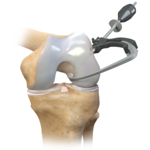 ACL Femoral Arm for StepCutter Jig (Left)