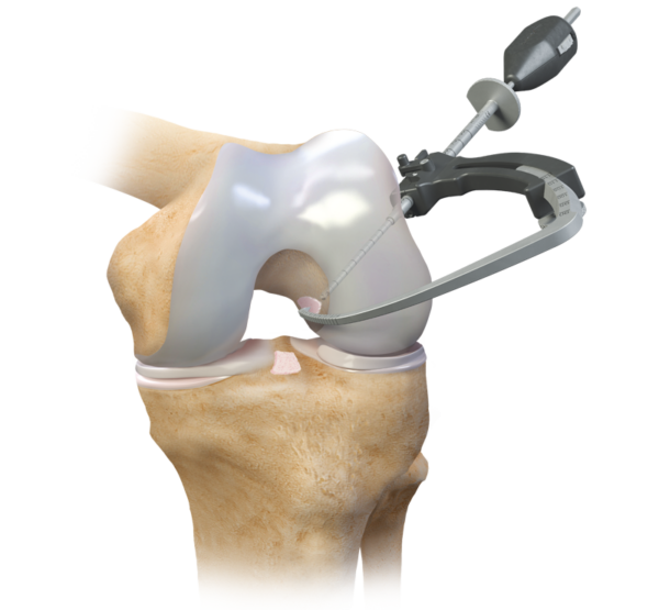 ACL Femoral Arm for StepCutter Jig (Left)